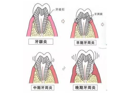 中老年人更应重视口腔卫生保健